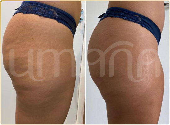 gluteo (3)