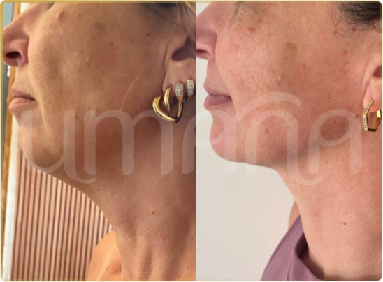 lipopapada