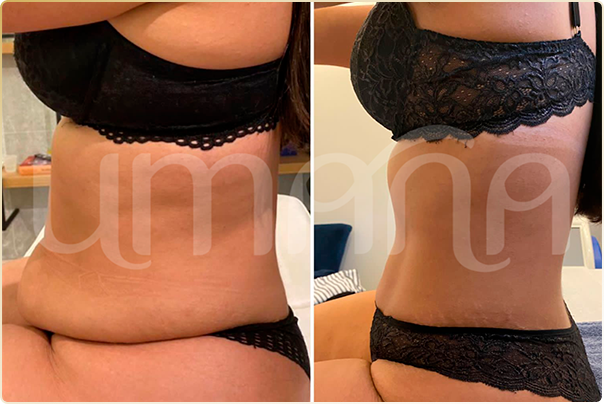 result lipo h (1)