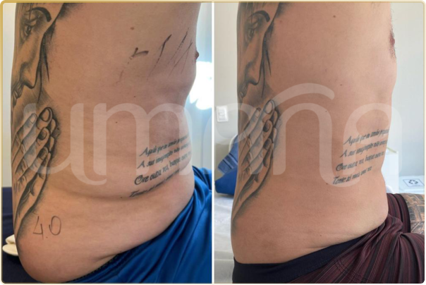 result lipo h (3)