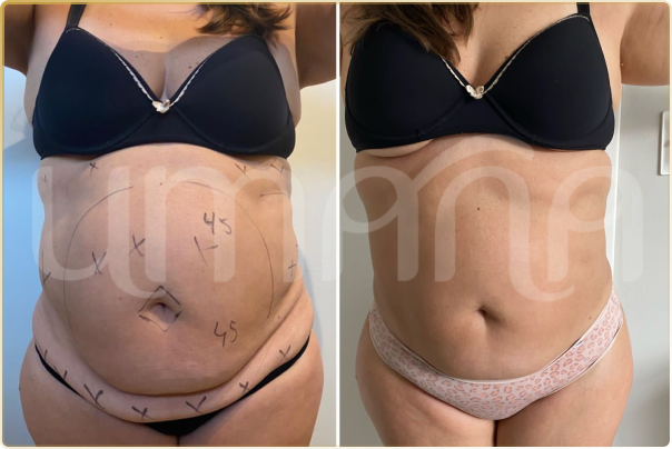 result lipo h (4)