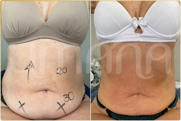 result lipo h (5)