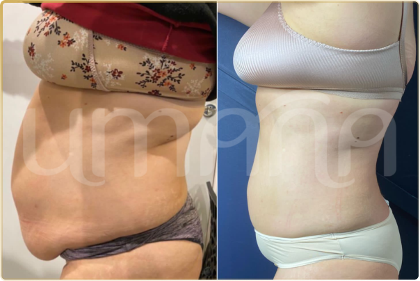 result lipo h (6)