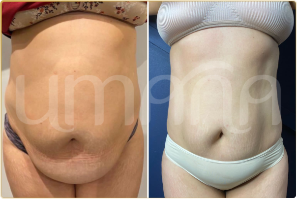 result lipo h (7)