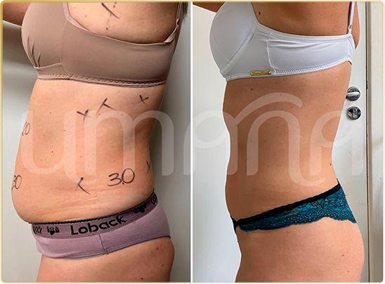 result lipo h (8)